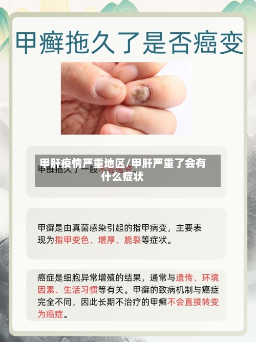 甲肝疫情严重地区/甲肝严重了会有什么症状
